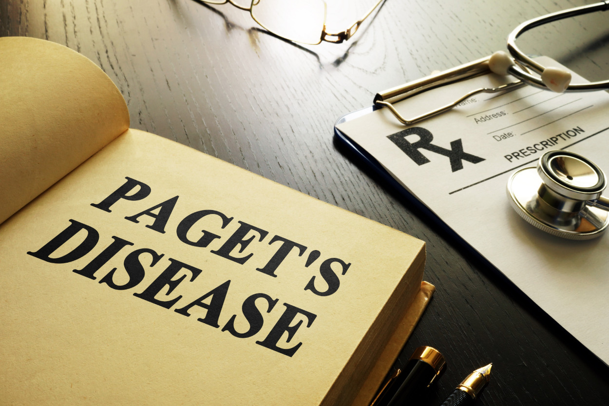Paget’s Disease