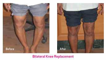 Joint, Knee, Hip Replacement Surgery in Chennai