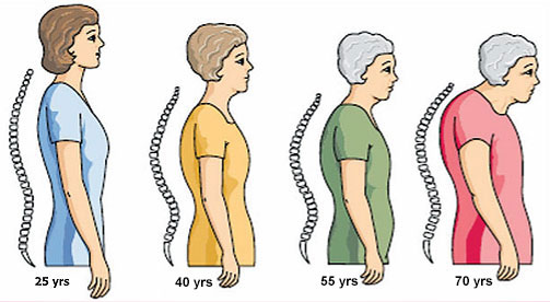 Osteoporosis Treatment in Chennai