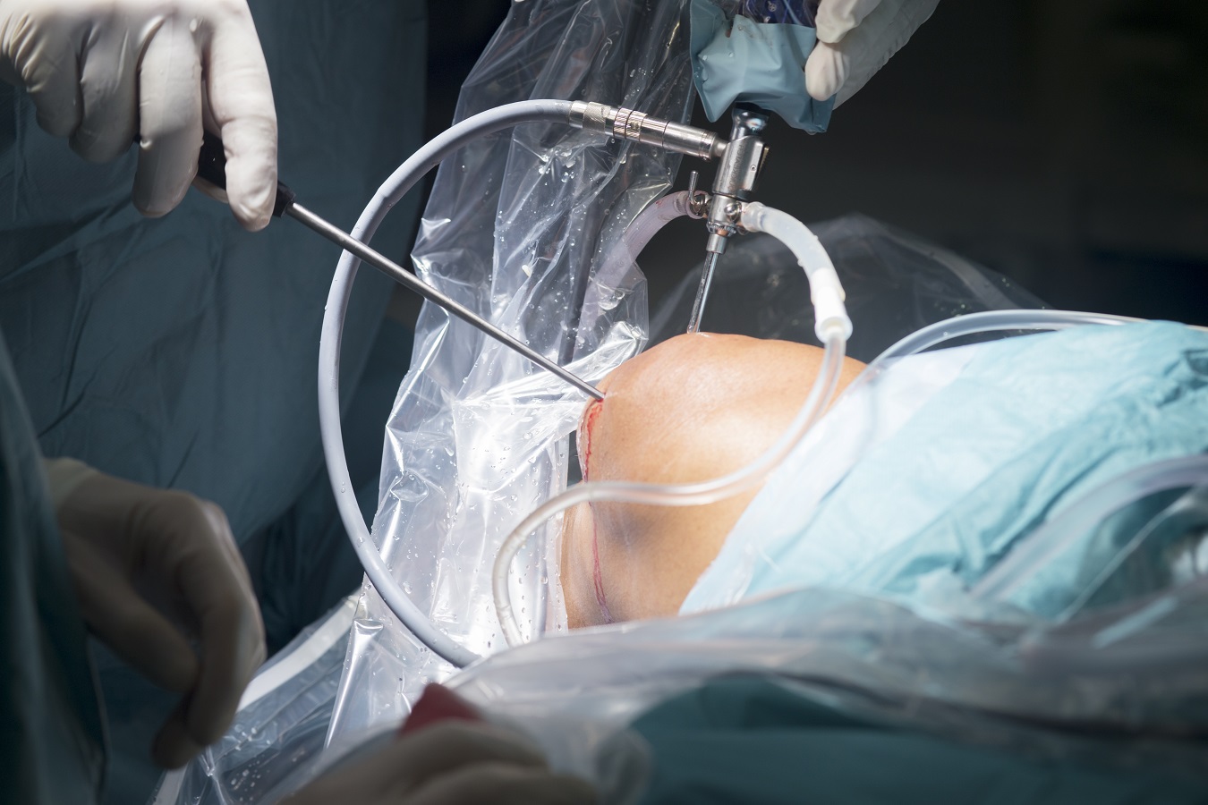 Reasons for Arthroscopic Knee Surgery